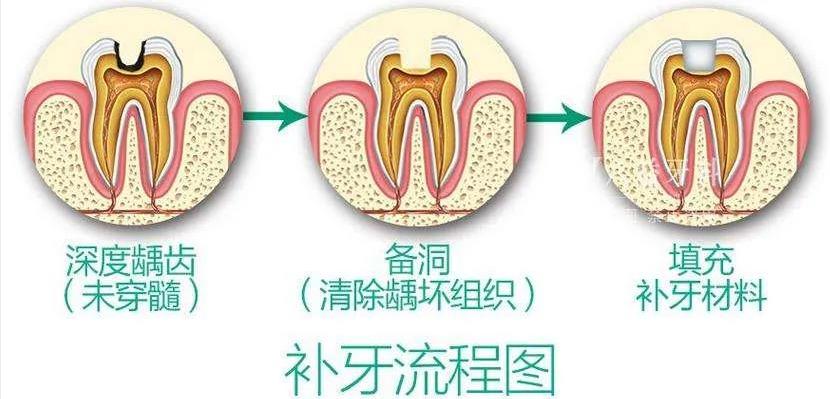 蛀牙不补还可以忍忍，补完牙反而更疼了！被坑坏了