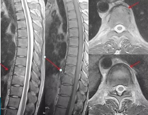 脊柱结核保守治疗大约需要多少钱,脊柱结核可以保守治疗
