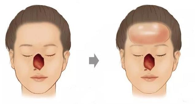 余文林鼻修复选择哪种材料更靠谱,余文林耳朵修复过程