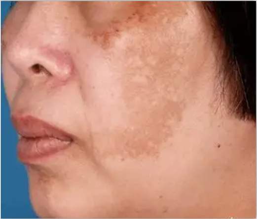 祛褐斑的最佳方法,去除褐斑的最好治疗方法