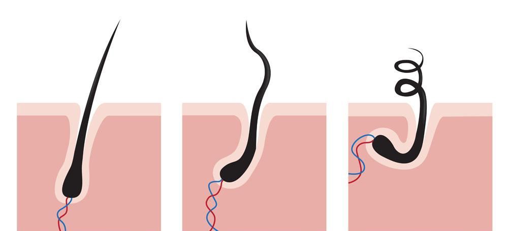 脂溢性脱发究竟是怎么回事呢？是否能够治疗呢？