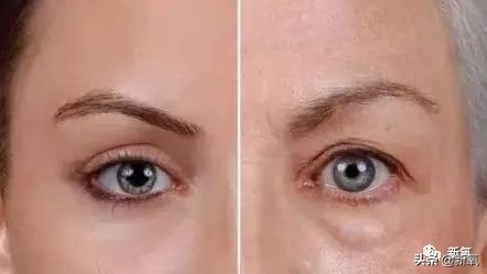 景甜修复后的双眼皮多宽,景甜修复之后的双眼皮是多宽