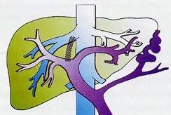 中医治疗肝硬化消化道出血,出奇制胜完整版