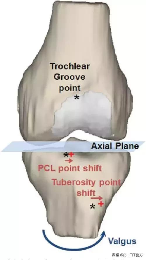 女性膝关节疼痛的最好治疗方法,为什么女性膝关节更容易出问题