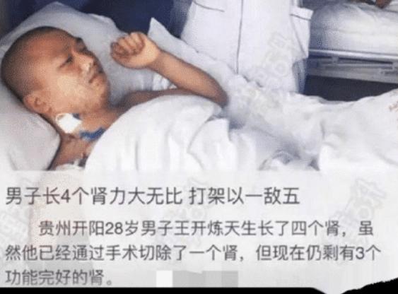 拥有四个肾的男人有多可怕,有4个肾的人有多苦恼