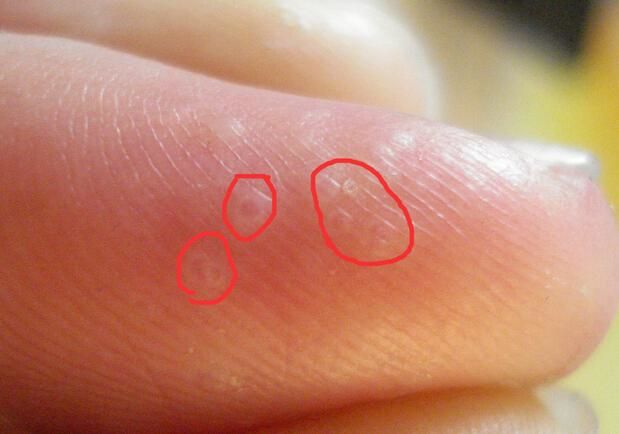 手上长小泡质地硬不痒是什么原因 (手上反复长了小血泡的原因)