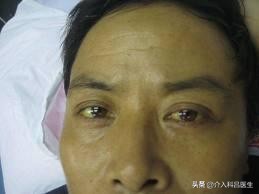 黄疸肝炎最佳治疗方法微创,黄疸最佳治疗方法微创