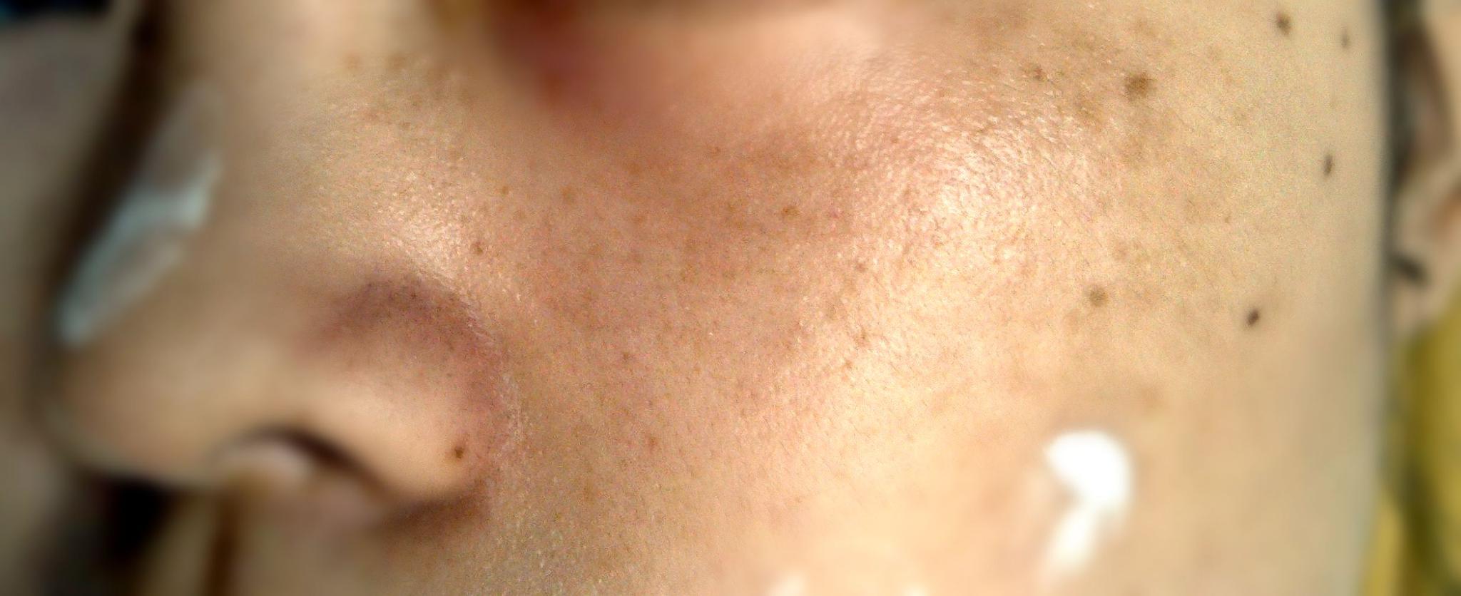 激光祛老年斑后斑更黑,激光点斑黑印多久恢复