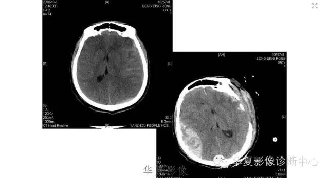 一文读懂颅内胆脂瘤,一文看懂背后的真相