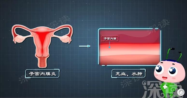 有盆腔炎是不是白带不正常,盆腔炎为什么会白带异常