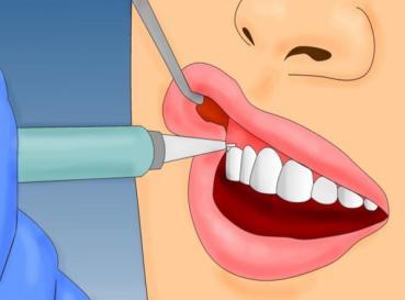 怀孕之前要把智齿拔掉吗,怀孕前要把所有的智齿拔了吗