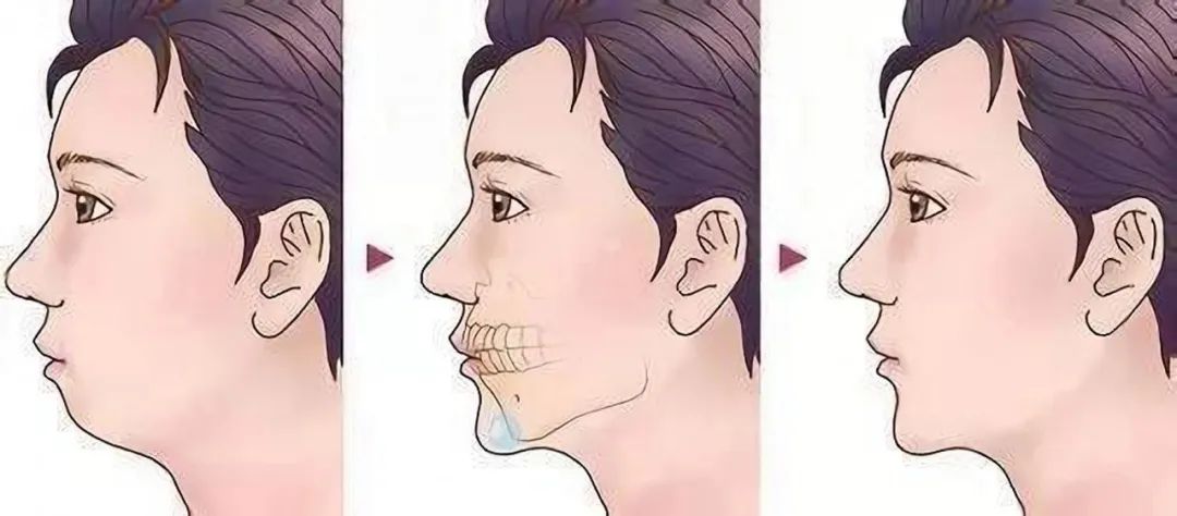 下巴短小和后缩嘴凸起好吗,下巴短小后缩但又有双下巴