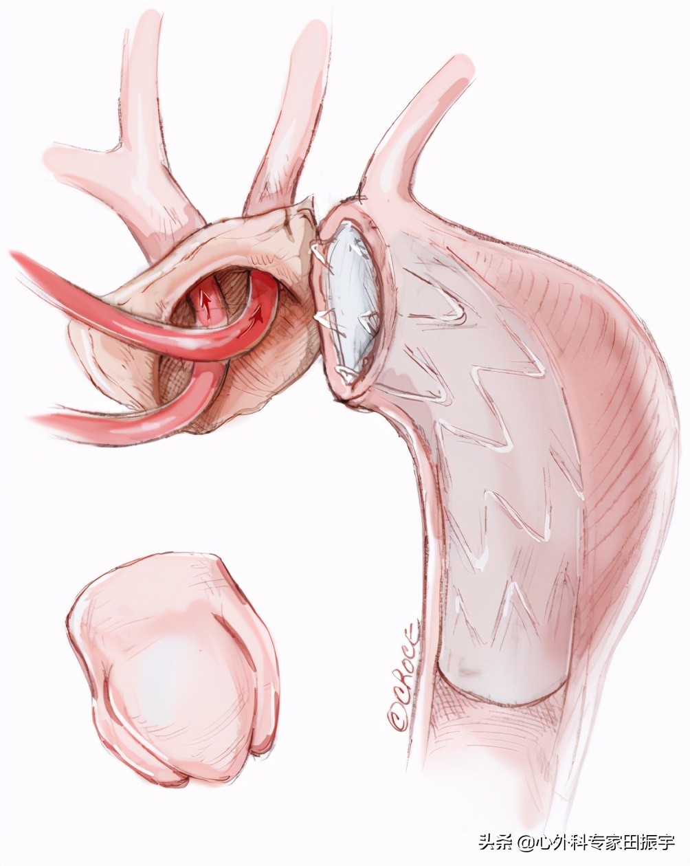 主动脉夹层破裂b型,急性主动脉夹层动脉瘤破裂
