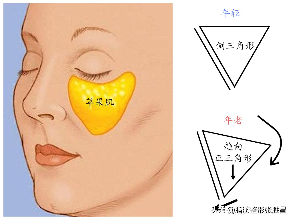 爱笑的女孩笑起来法令纹很明显,笑的时候有法令纹的人怎么样