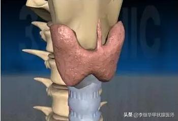 t3型甲亢治疗,t3型甲亢是什么意思