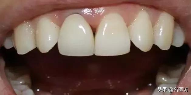 牙缝里有黑黑的怎样正确刷牙,牙缝里面有黑黑的东西是什么