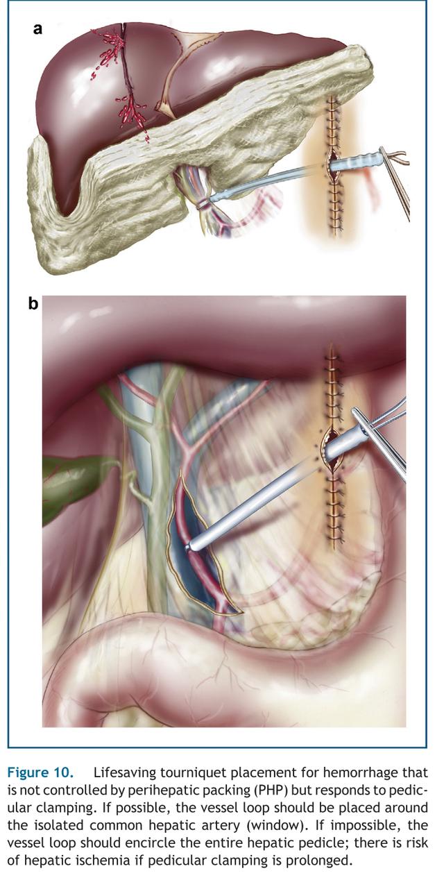 肝脏损伤的诊断和处理,肝脏损伤ii级