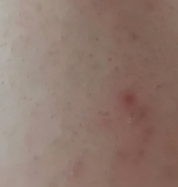 消灭黑头，男女都一样，颜值加倍