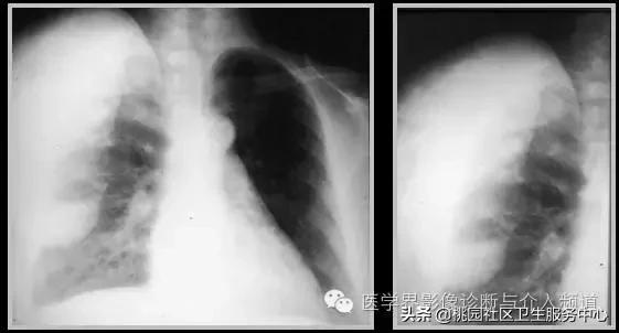 软组织钙化是不是骨化性肌炎,软组织钙化或骨化