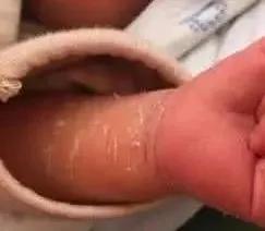 马牙宝宝有什么表现,马牙婴儿怎么治疗