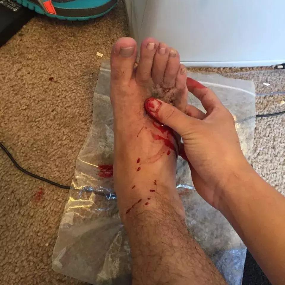 中国留学生被截肢,励志留学生