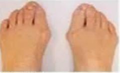 拇外翻陈医生,骨科陈医生治脚后跟疼痛