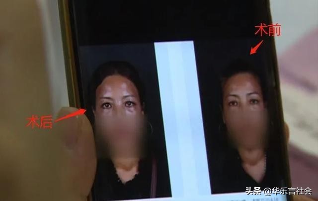 女子整容脂肪填充瘫痪,女子整容额头