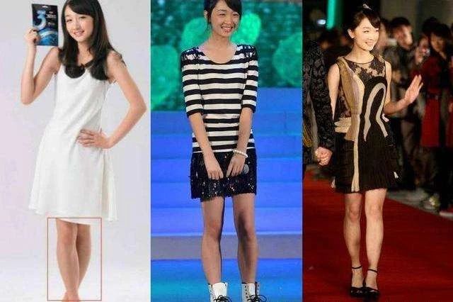 怎么判断小腿肌肉外翻和骨骼弯曲,小腿肌肉外翻和膝盖内扣一样吗