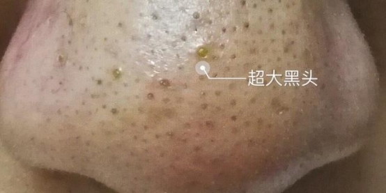 婴儿黑头怎么处理脸颊,如何去黑头5个诀窍告别草莓鼻