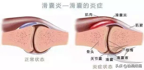 老年人膝盖水肿痛的三大病因,左脚膝盖后面酸痛是什么病因