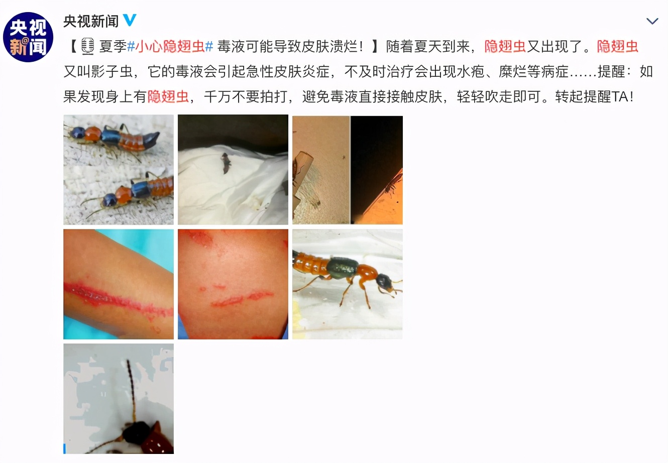 隐翅虫爬到脸上该怎么办,孩子被隐翅虫伤害了怎么办