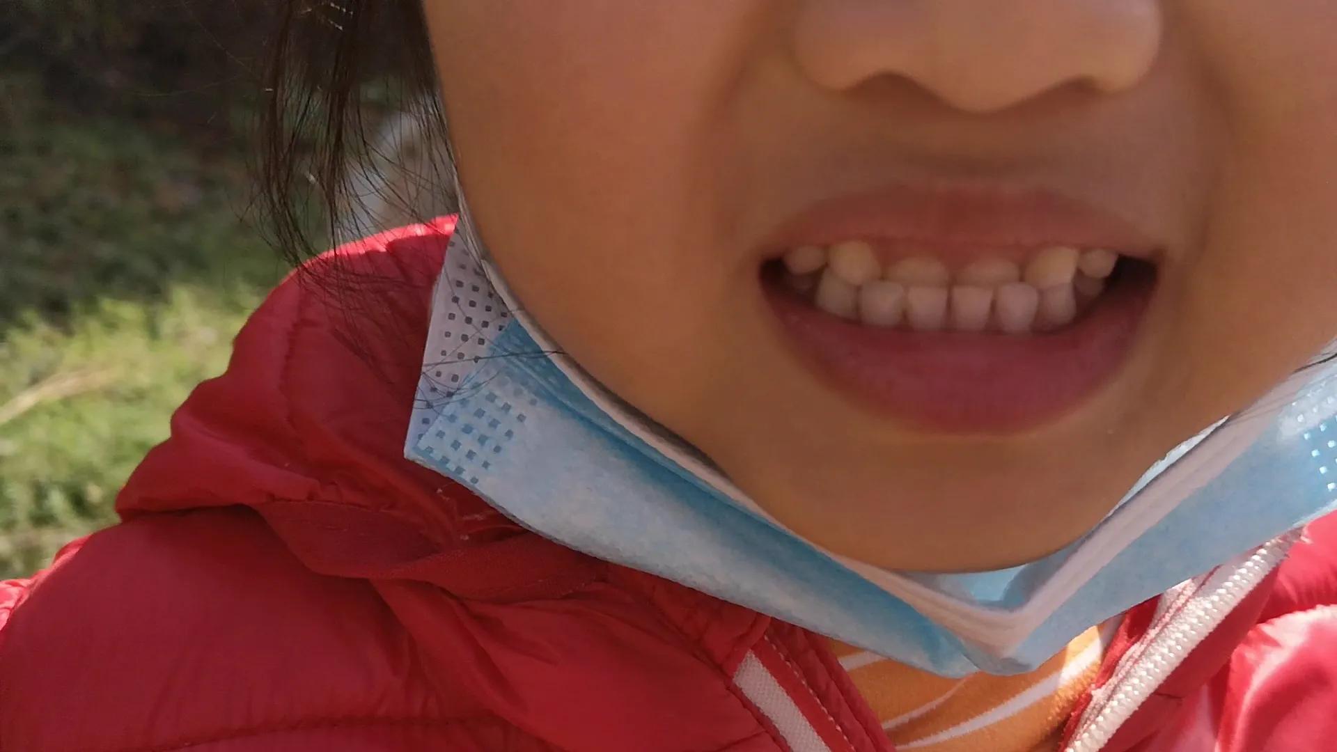 6-12岁地包天牙齿矫正多少钱,10-16岁小孩牙齿矫正多少钱