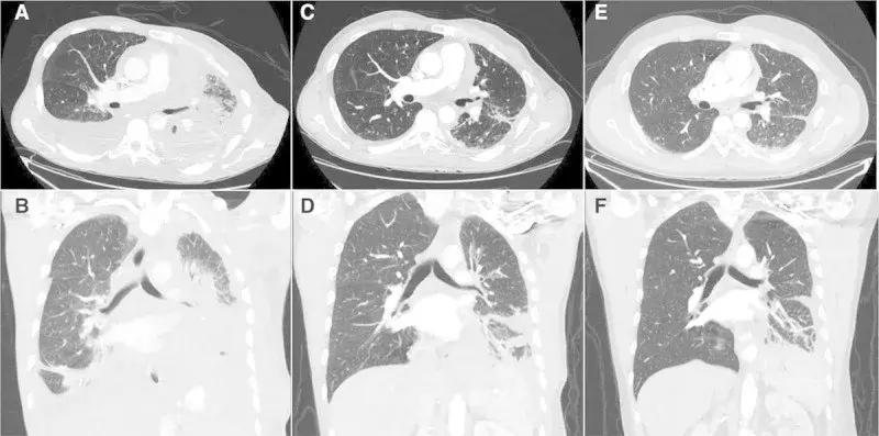 最新国外抗癌药,世界公认最好的抗癌药