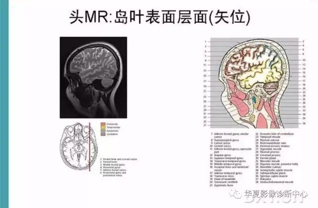 mra头颅解剖学详细讲解视频,常见的头颅mri图像