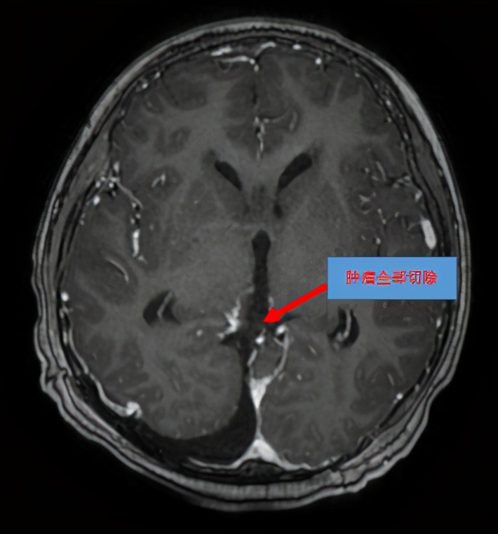 13岁孩子玩手机游戏患脑梗,12岁小男孩玩游戏猝死事件