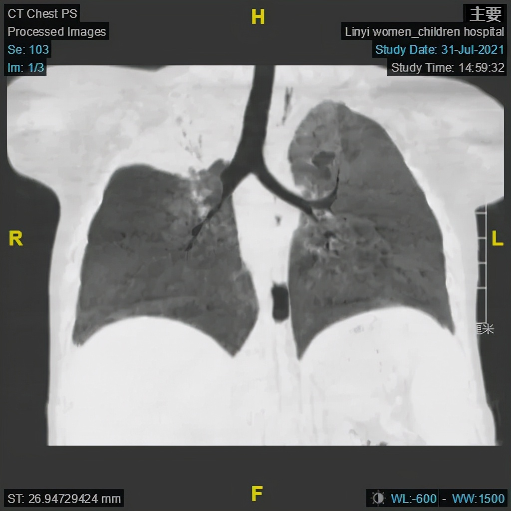肺炎支气管镜一般费用多少,肺炎不好反复发烧