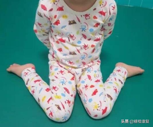 扁平足的锻炼矫正方法,10岁小孩扁平足的矫正方法