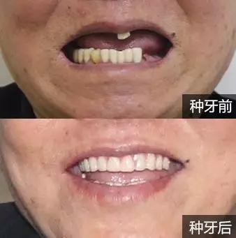 烤瓷牙套里的牙烂了有什么症状,烤瓷牙牙套里的牙烂了怎么处理