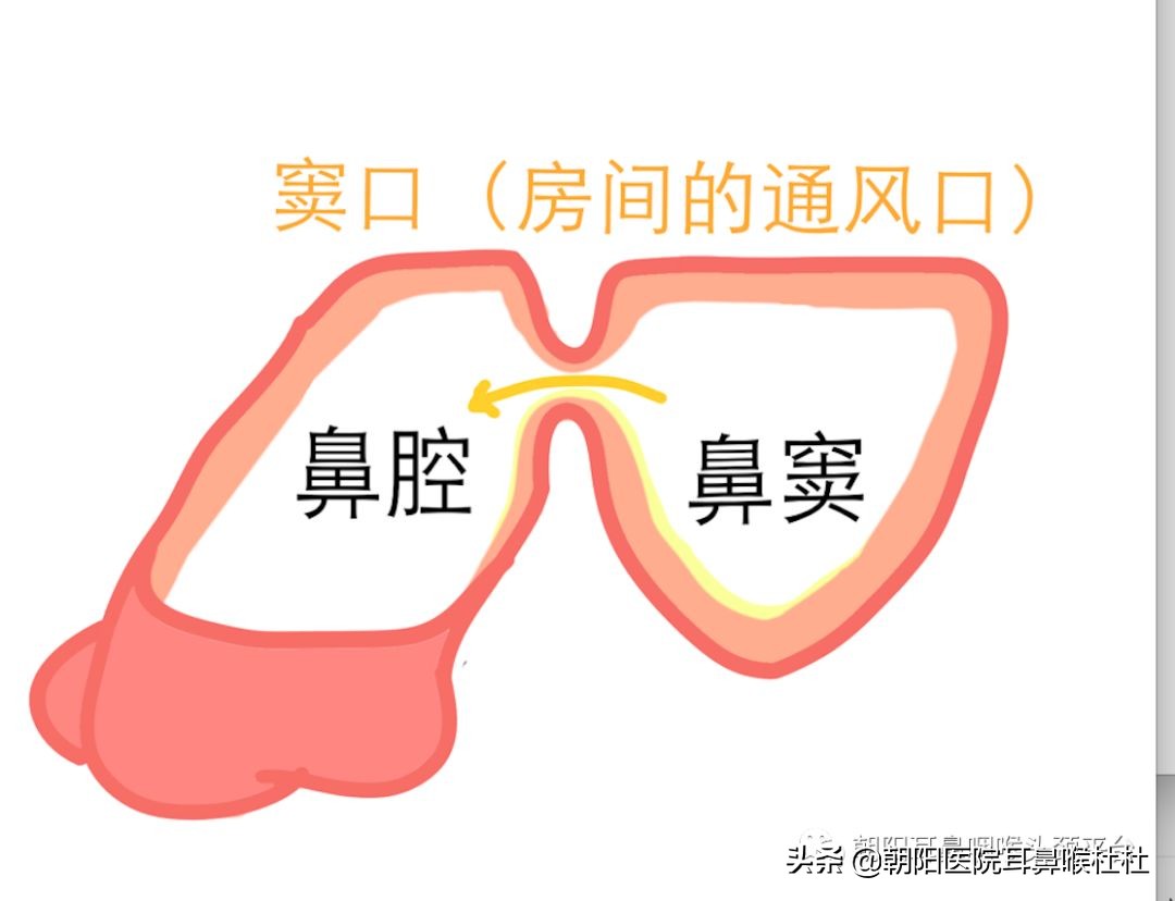 急性鼻窦炎头痛早上轻午后重,头痛鼻窦炎