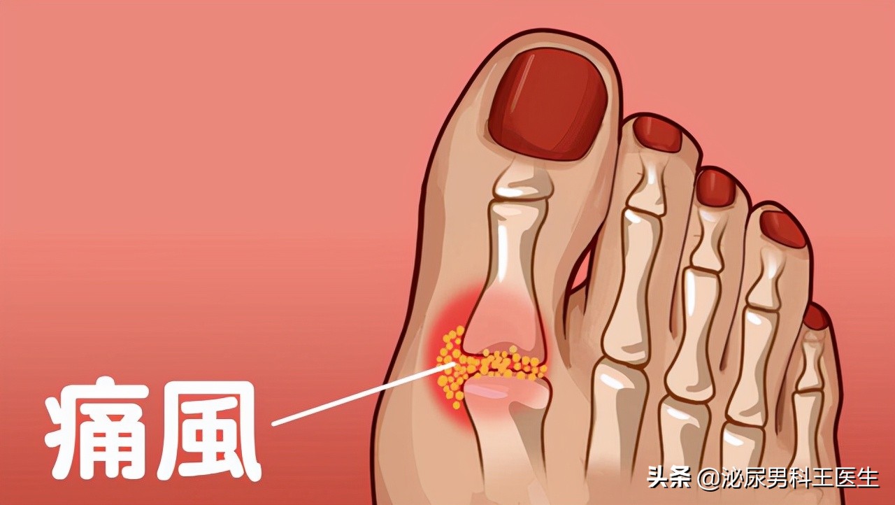 尿酸高身体会出现哪些症状,尿酸高怎么调理下来还需要吃药