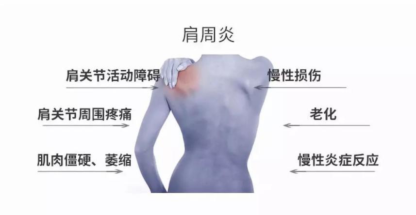 肩关节周围炎不适的运动康复疗法