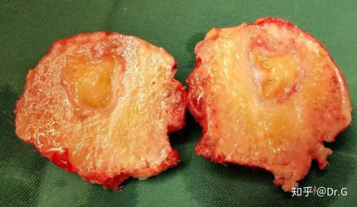 短时间用激素一定会股骨头坏死吗,没服过激素会股骨头坏死吗