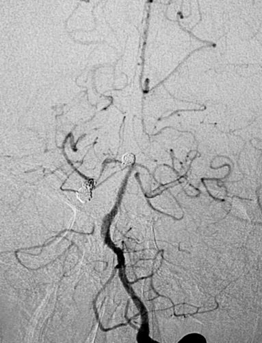 颅内巨大动脉瘤首选治疗技术,大脑中动脉动脉瘤闭塞的介入治疗