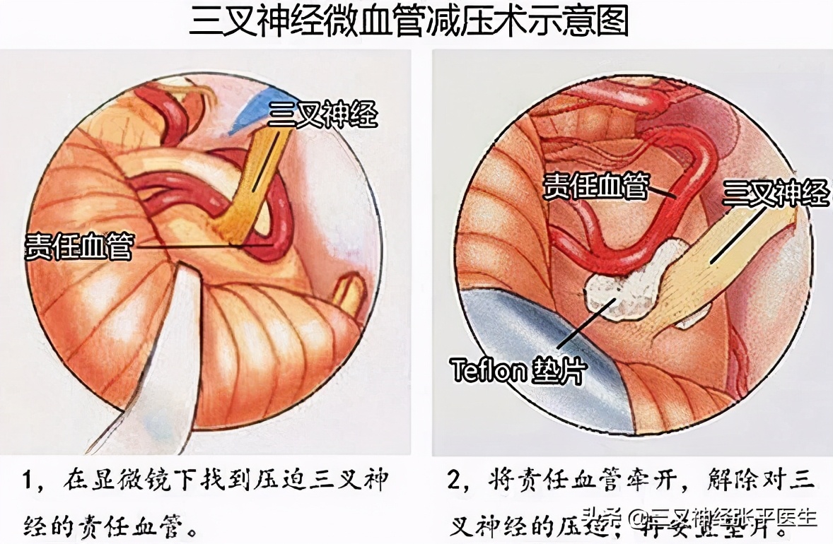继发性三叉神经与原发性三叉神经,三叉神经痛原发性和继发性的区别