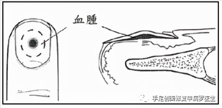 甲下积血放血后如何止血,甲下积血怎么办