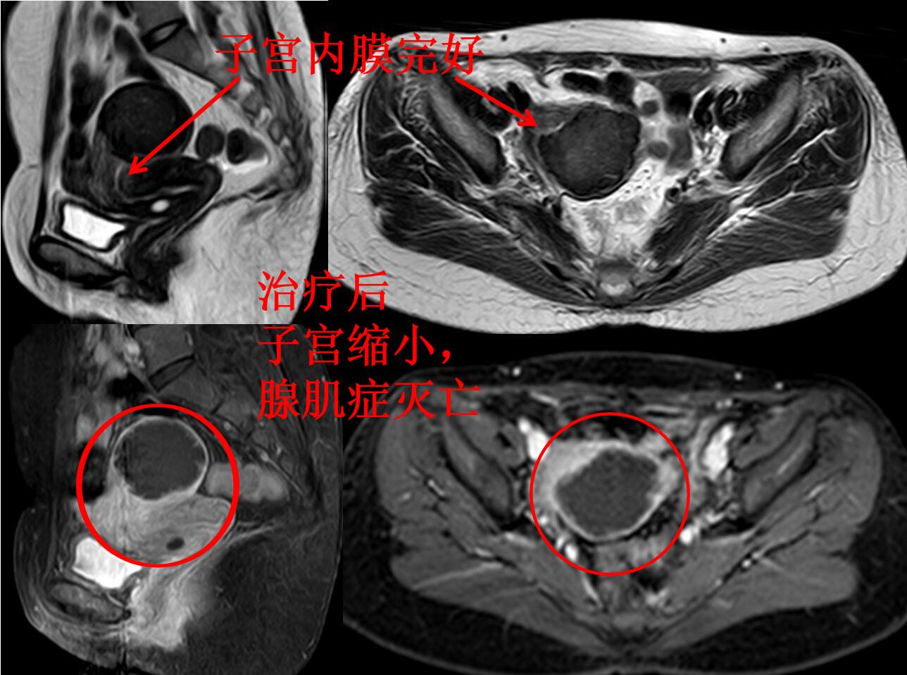 看看痛不欲生的子宫腺肌症痛经专业领域的看法与典型病例