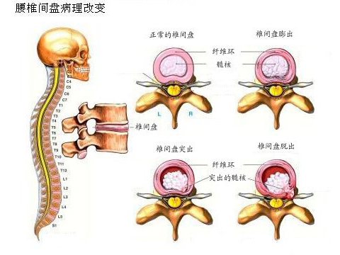 腰椎间盘膨出突出脱出有区别吗,腰椎间盘膨出和突出的中医治疗