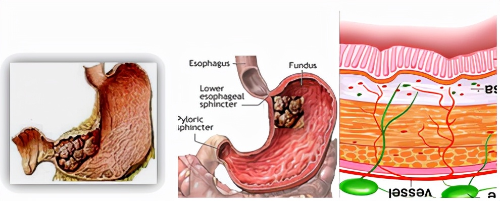 我不是药神，我不是财迷！若患胃癌，这些靶向药你有能力负担吗？