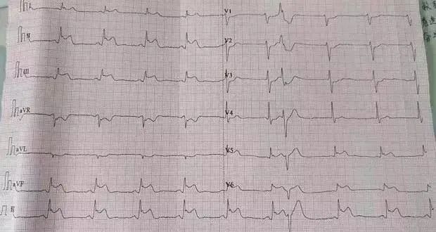 32岁北大博士心梗猝死,知名医生突发心梗