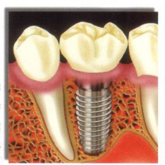 现在最便宜的假牙多少钱一颗,目前国内最好的假牙是多少钱